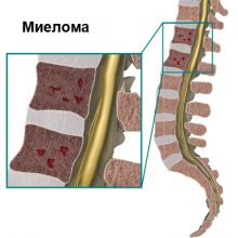 Выявление множественной миеломы